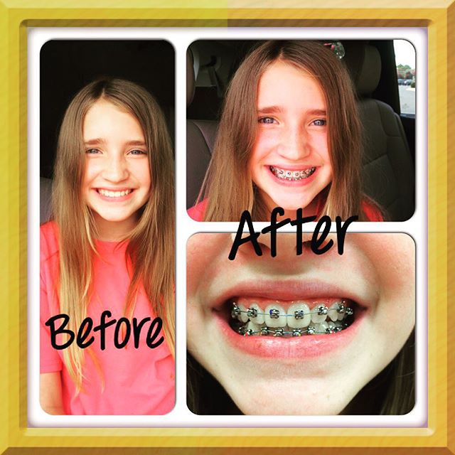 Lucy got braces today!! Whoo Hoo! #BraceYourFace #braces #MetalMouth